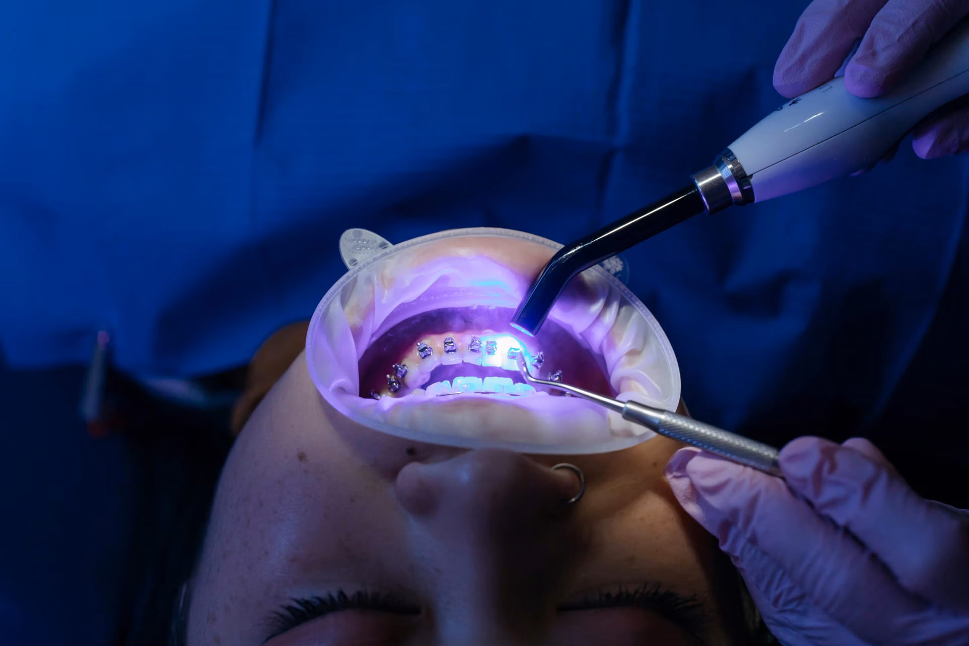 Teeth Whitening - DR Gutgarts
